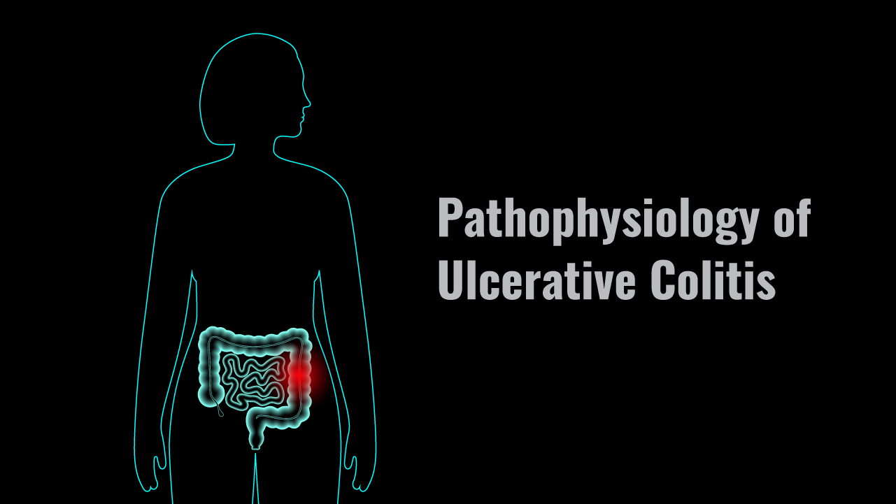 Pathophysiology of Ulcerative Colitis