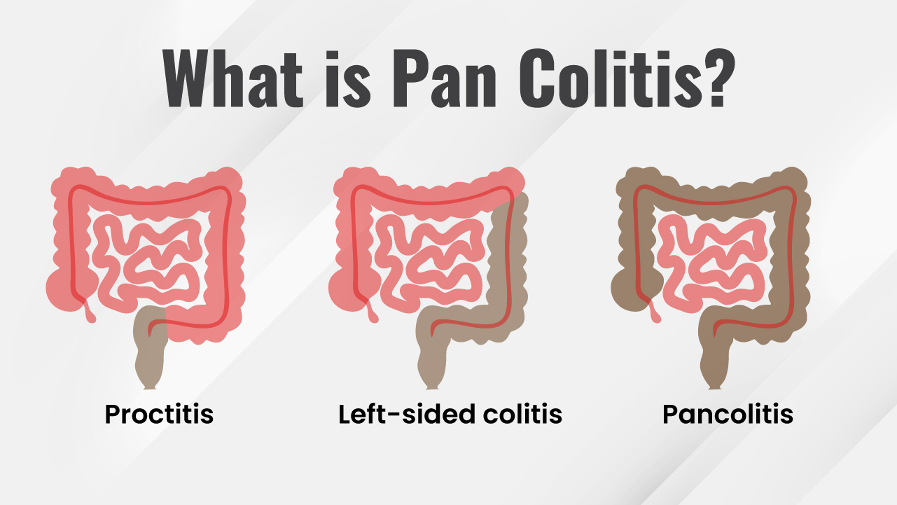 What is Pancolitis ?